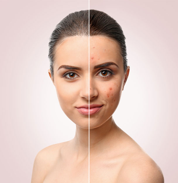 acne scarring St Petersburg