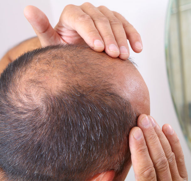 Hair Transplant Tampa