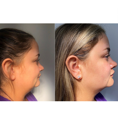 Fillers & Jaw Line Sculpting